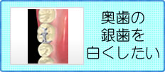 奥歯の銀歯を白くしたい方はこちら