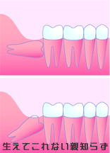 親知らずが引き起こすトラブル