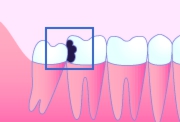 親知らずの前の歯が虫歯や歯周病になる