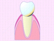 プラークが石灰化した歯石