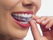 ホワイトニング