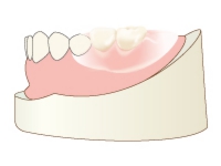 ノンクラスプデンチャー