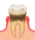 不衛生な入れ歯が引き起こす身体への悪影響